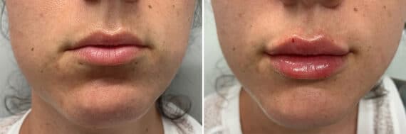 Injectable Fillers Before and After Photos in Philadelphia, PA, Patient 4742