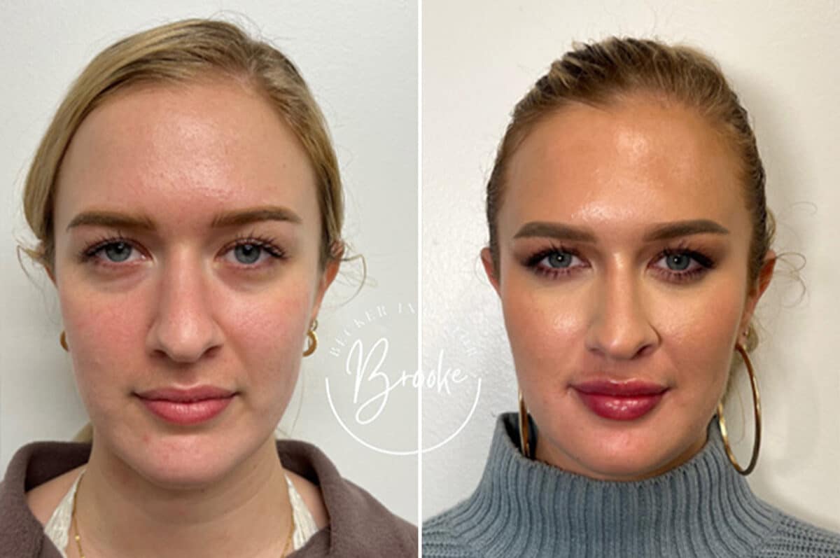 Injectable Fillers Before and After Photos in Philadelphia, PA, Patient 4776