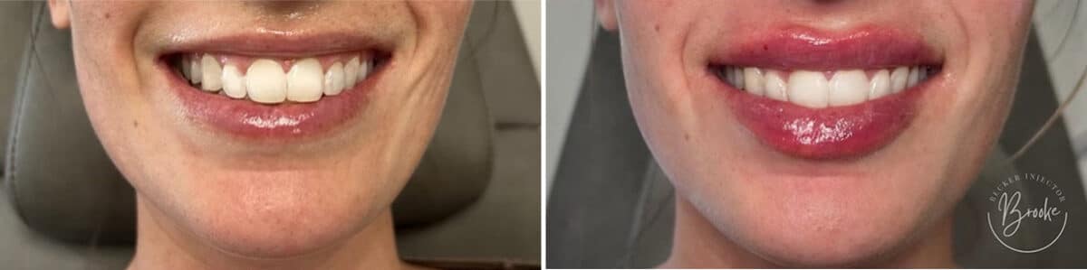 Lip Augmentation Before and After Photos in Philadelphia, PA, Patient 4814