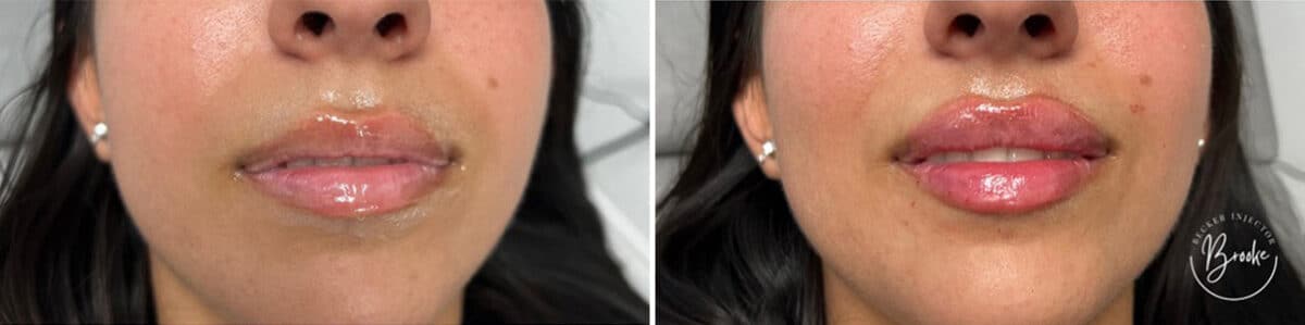 Lip Augmentation Before and After Photos in Philadelphia, PA, Patient 4815