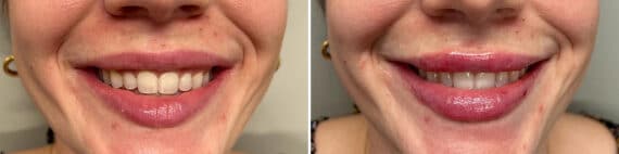 Lip Augmentation Before and After Photos in Philadelphia, PA, Patient 4817