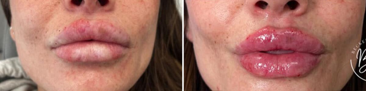 Lip Augmentation Before and After Photos in Philadelphia, PA, Patient 4819