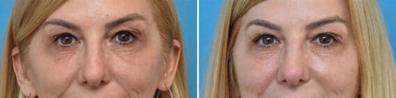 Botox Before and After Photos in Philadelphia, PA, Patient 4865