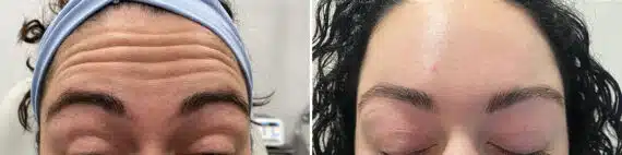 Botox Before and After Photos in Philadelphia, PA, Patient 4866