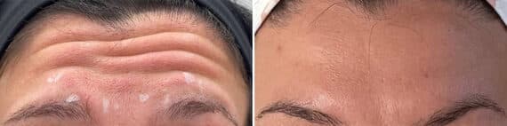 Botox Before and After Photos in Philadelphia, PA, Patient 4869