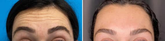 Botox Before and After Photos in Philadelphia, PA, Patient 4871