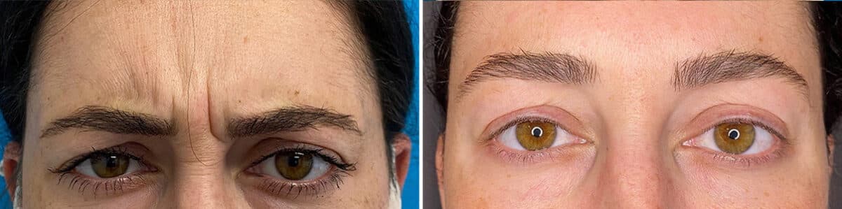 Botox Before and After Photos in Philadelphia, PA, Patient 4872