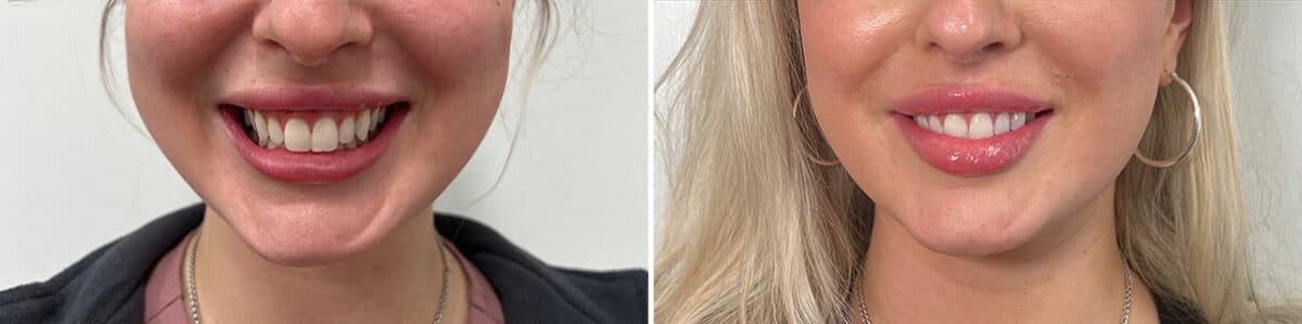 Botox Before and After Photos in Philadelphia, PA, Patient 4873