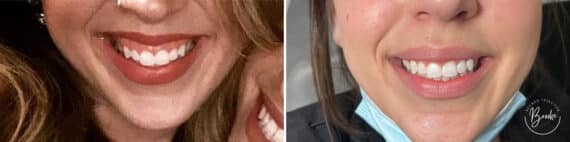 Botox Before and After Photos in Philadelphia, PA, Patient 4874