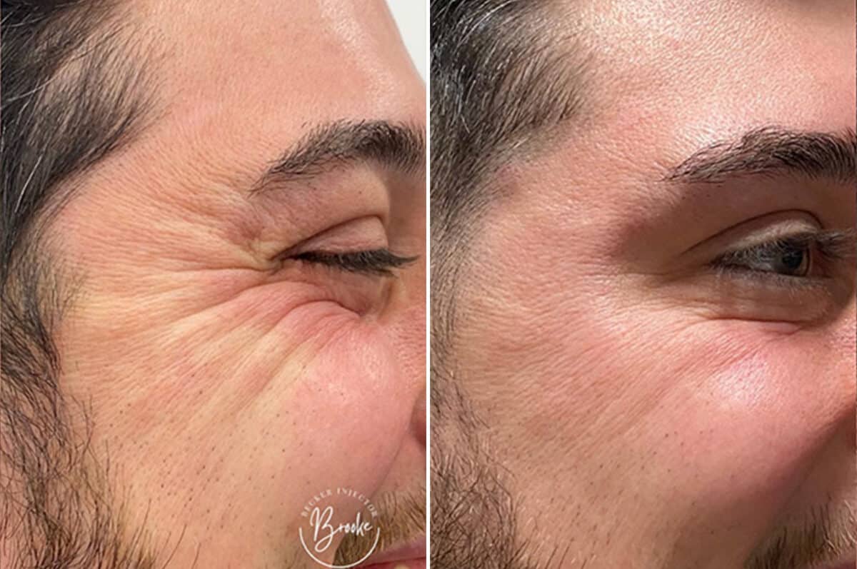 Botox Before and After Photos in Philadelphia, PA, Patient 4876