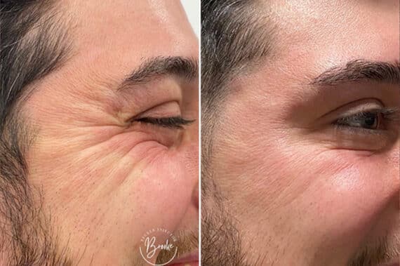 Botox Before and After Photos in Philadelphia, PA, Patient 4876