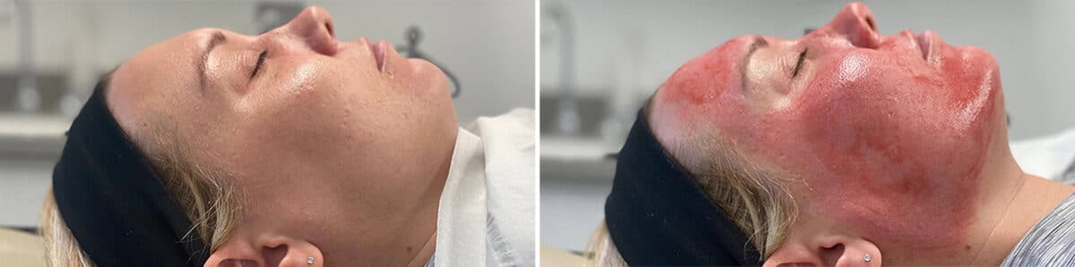 Microneedling Before and After Photos in Philadelphia, PA, Patient 4913