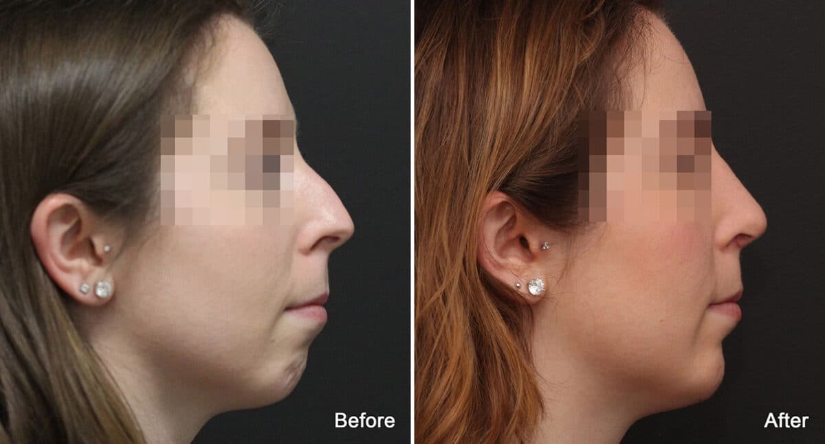 Chin Implants Before and After Photos in Princeton, NJ, Patient 760