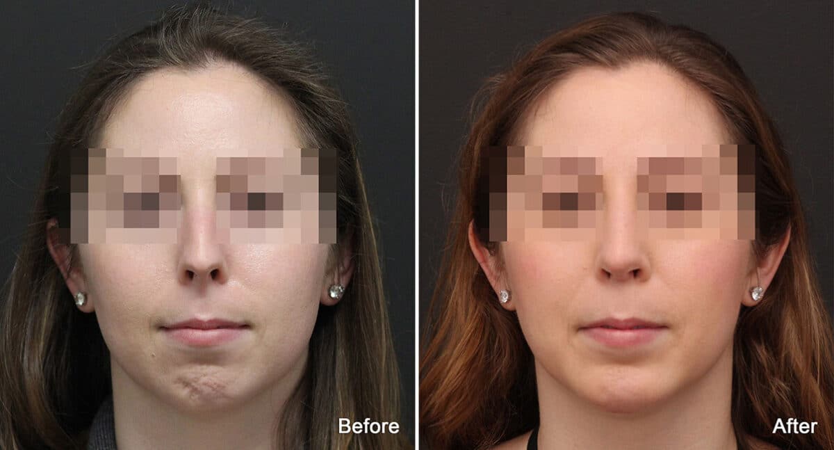 Chin Implants Before and After Photos in Princeton, NJ, Patient 760