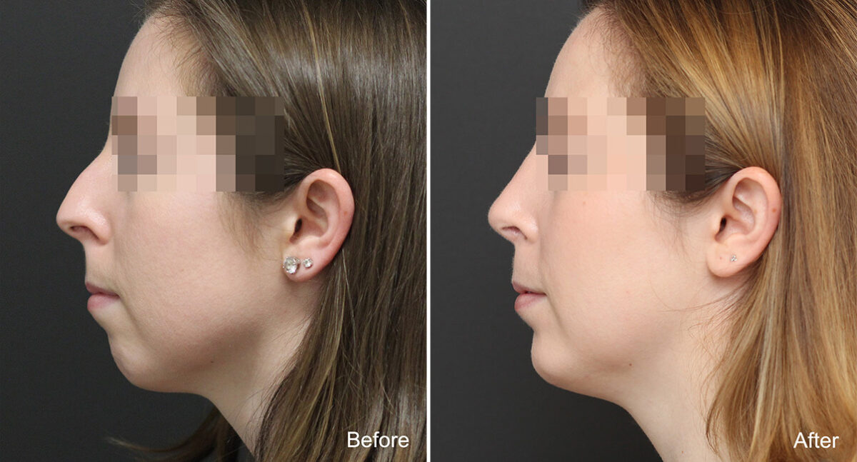 Chin Implants Before and After Photos in Princeton, NJ, Patient 760