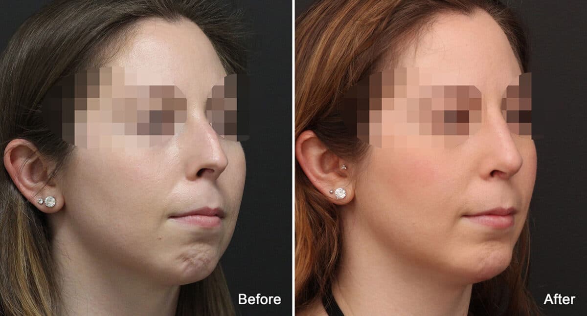 Chin Implants Before and After Photos in Princeton, NJ, Patient 760