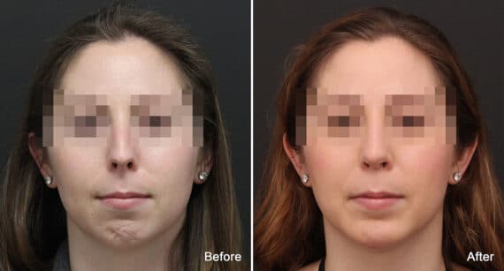 Chin Implants Before and After Photos in Princeton, NJ, Patient 760