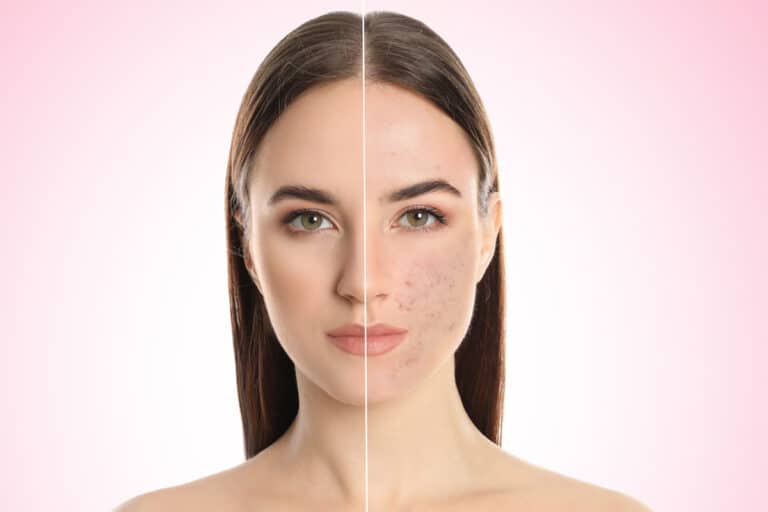 Facelifts can help patients rid of their acne scars and achieve smoother, younger-looking skin.