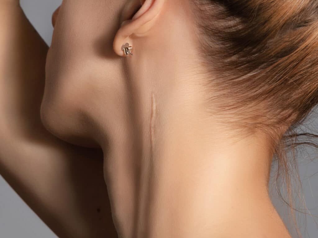 Becker Plastic Surgery can provide a wide range of scar revision options. From light and laser treatment to a Z-plastic surgical procedure, our team can help you achieve the best possible outcome