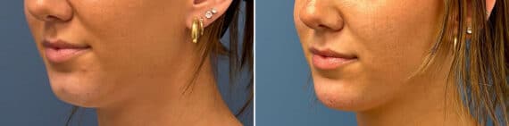 Injectable Fillers Before and After Photos in Philadelphia, PA, Patient 5187