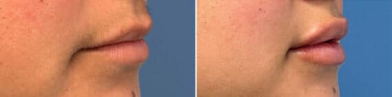 Injectable Fillers Before and After Photos in Philadelphia, PA, Patient 5197