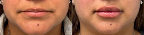 Injectable Fillers Before and After Photos in Philadelphia, PA, Patient 5197