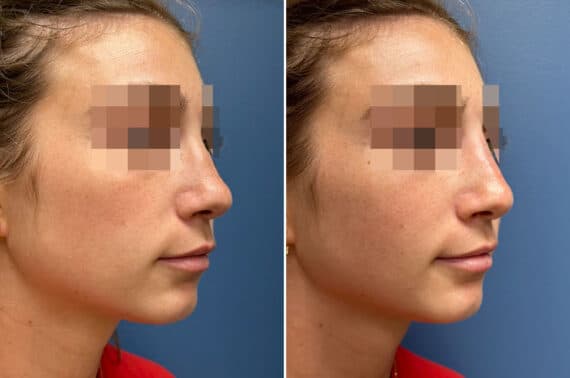 Liquid Rhinoplasty Before and After Photos in Philadelphia, PA, Patient 5207