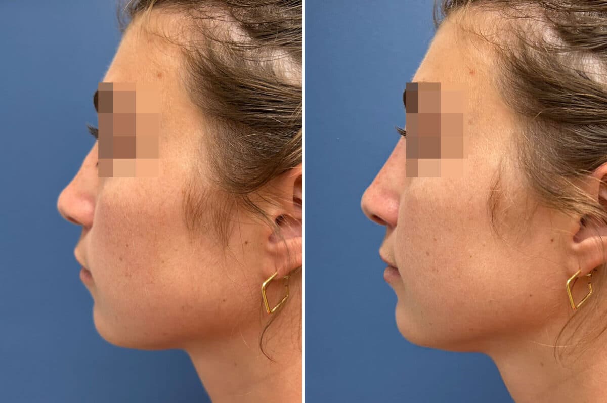 Liquid Rhinoplasty Before and After Photos in Philadelphia, PA, Patient 5207
