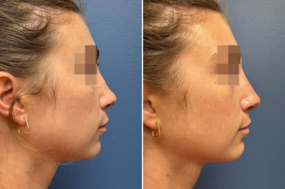 Liquid Rhinoplasty Before and After Photos in Philadelphia, PA, Patient 5207