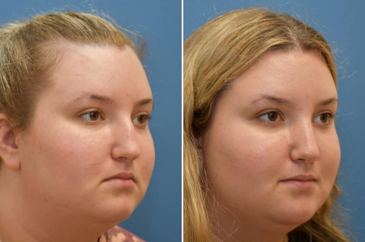 Rhinoplasty Before and After Photos in Philadelphia, PA, Patient 5450