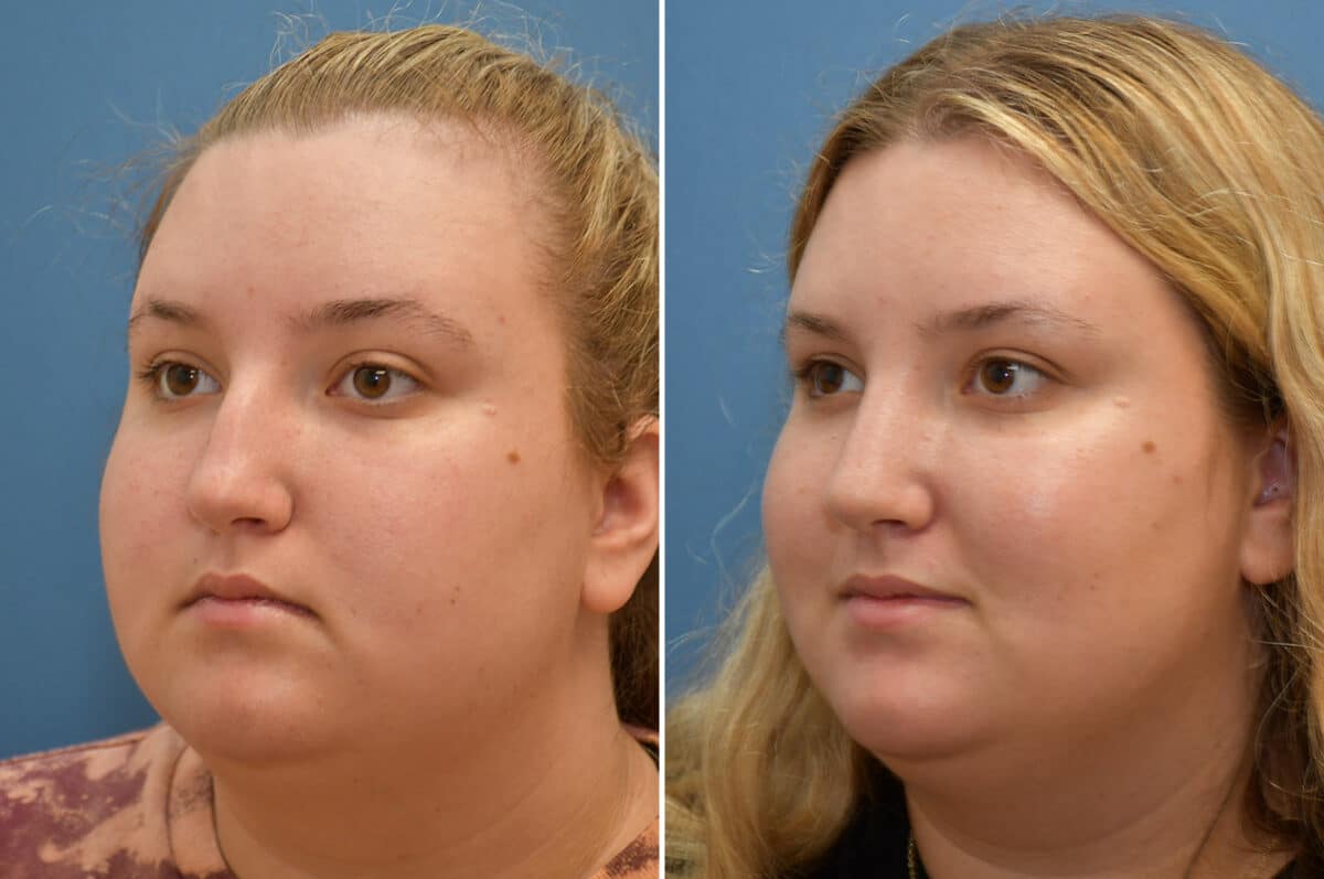 Rhinoplasty Before and After Photos in Philadelphia, PA, Patient 5450