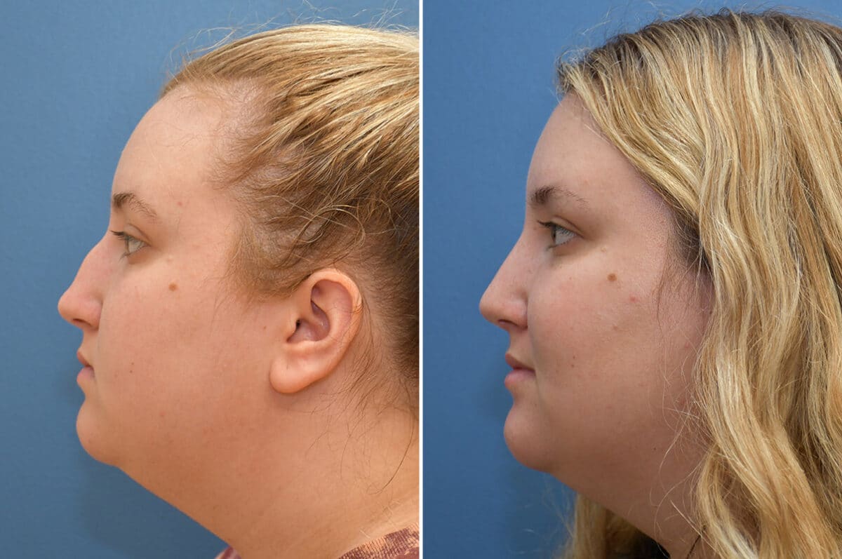 Rhinoplasty Before and After Photos in Philadelphia, PA, Patient 5450