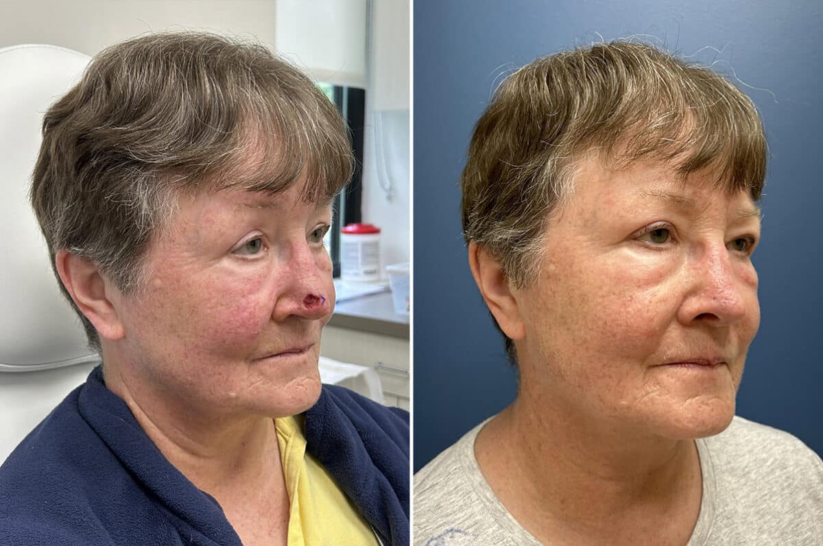 Patient 5483, Mohs Reconstruction Before and After Photos Mohs Reconstruction Before and After Photos in Philadelphia, PA, Patient 5483