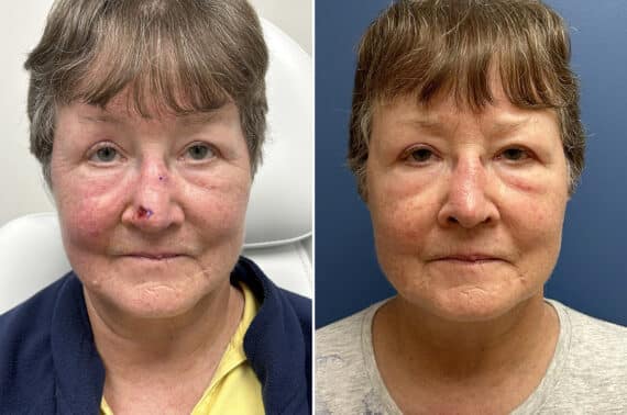 Mohs Reconstruction Before and After Photos in Philadelphia, PA, Patient 5483