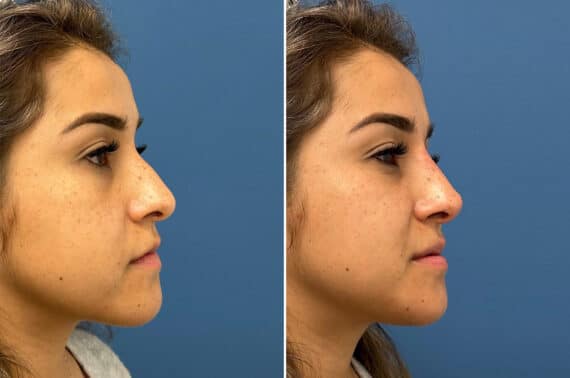 Liquid Rhinoplasty Before and After Photos in Philadelphia, PA, Patient 5490