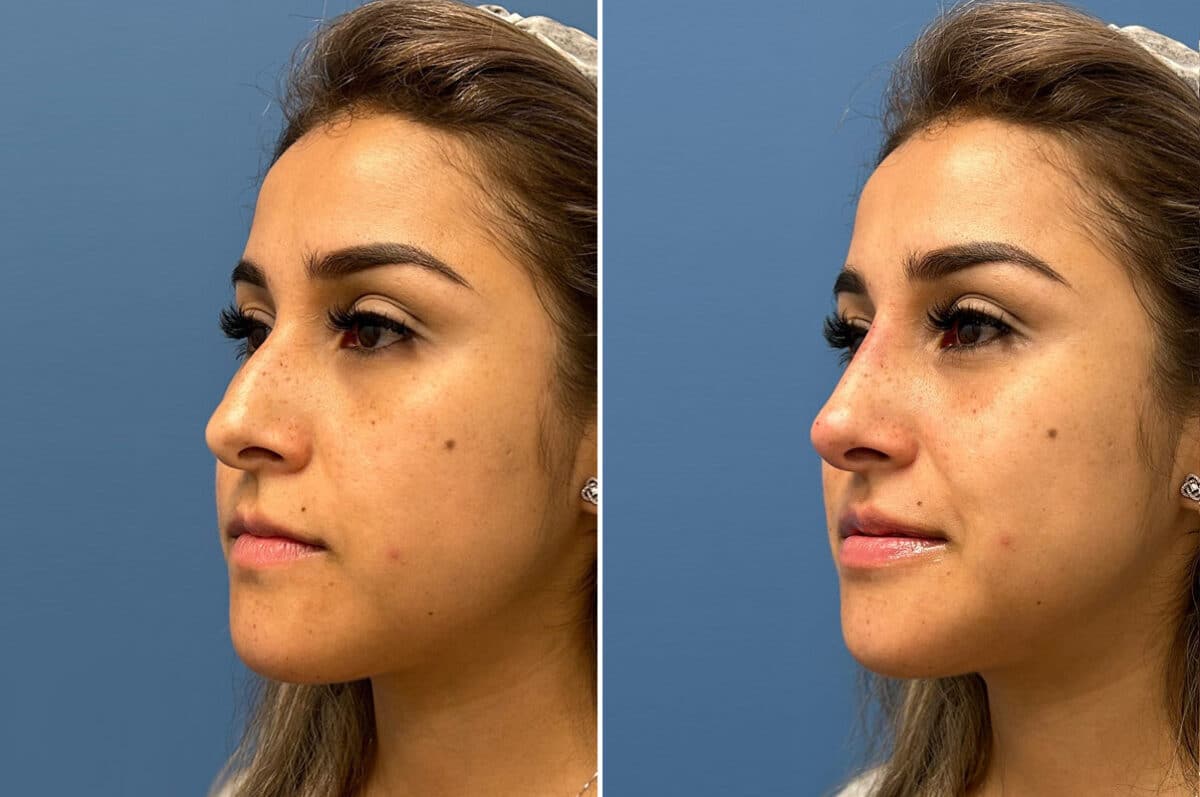 Liquid Rhinoplasty Before and After Photos in Philadelphia, PA, Patient 5490
