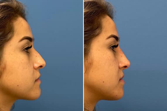 Liquid Rhinoplasty Before and After Photos in Philadelphia, PA, Patient 5490