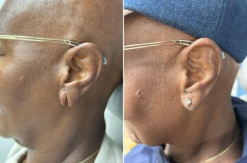 Otoplasty Before and After Photos in Philadelphia, PA, Patient 5532