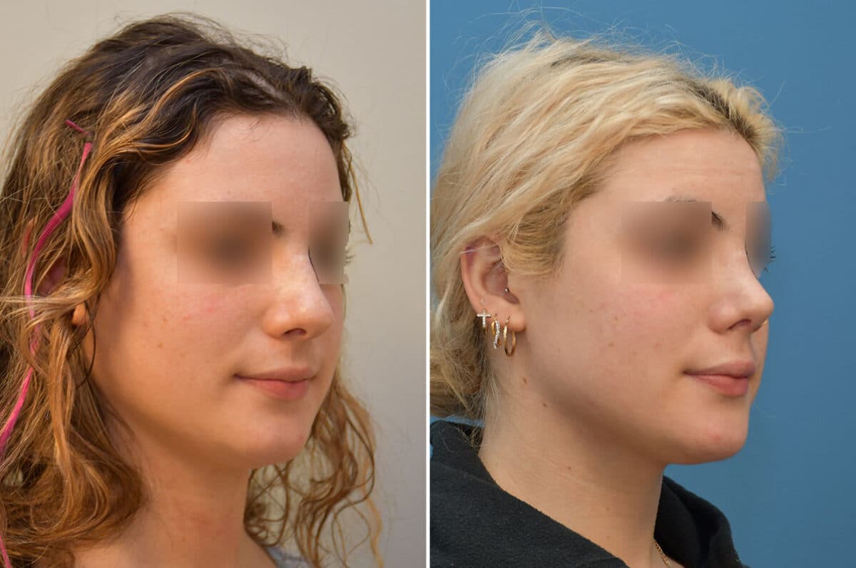 Patient 5808, Rhinoplasty Before and After Photos Rhinoplasty Before and After Photos in Philadelphia, PA, Patient 5808