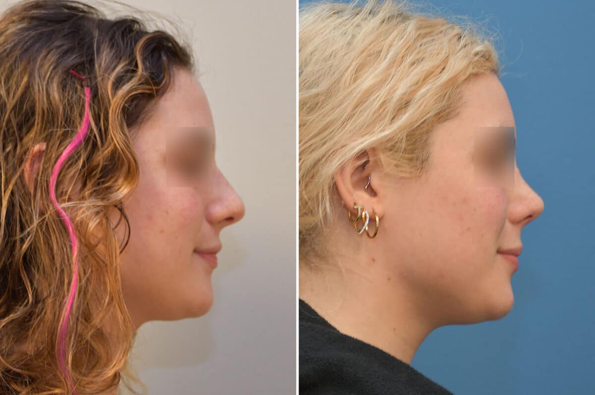 Patient 5808, Rhinoplasty Before and After Photos Rhinoplasty Before and After Photos in Philadelphia, PA, Patient 5808