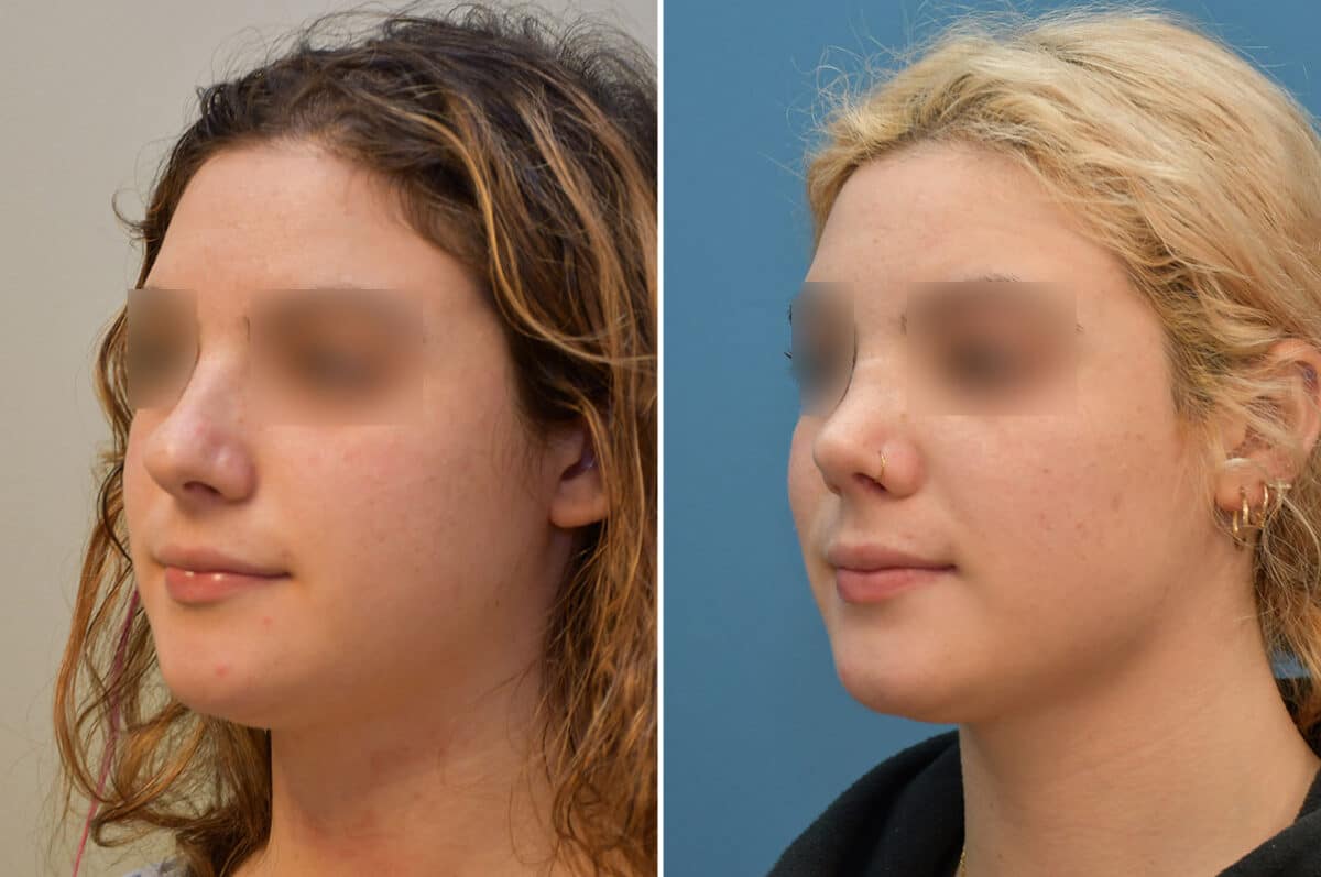 Patient 5808, Rhinoplasty Before and After Photos Rhinoplasty Before and After Photos in Philadelphia, PA, Patient 5808