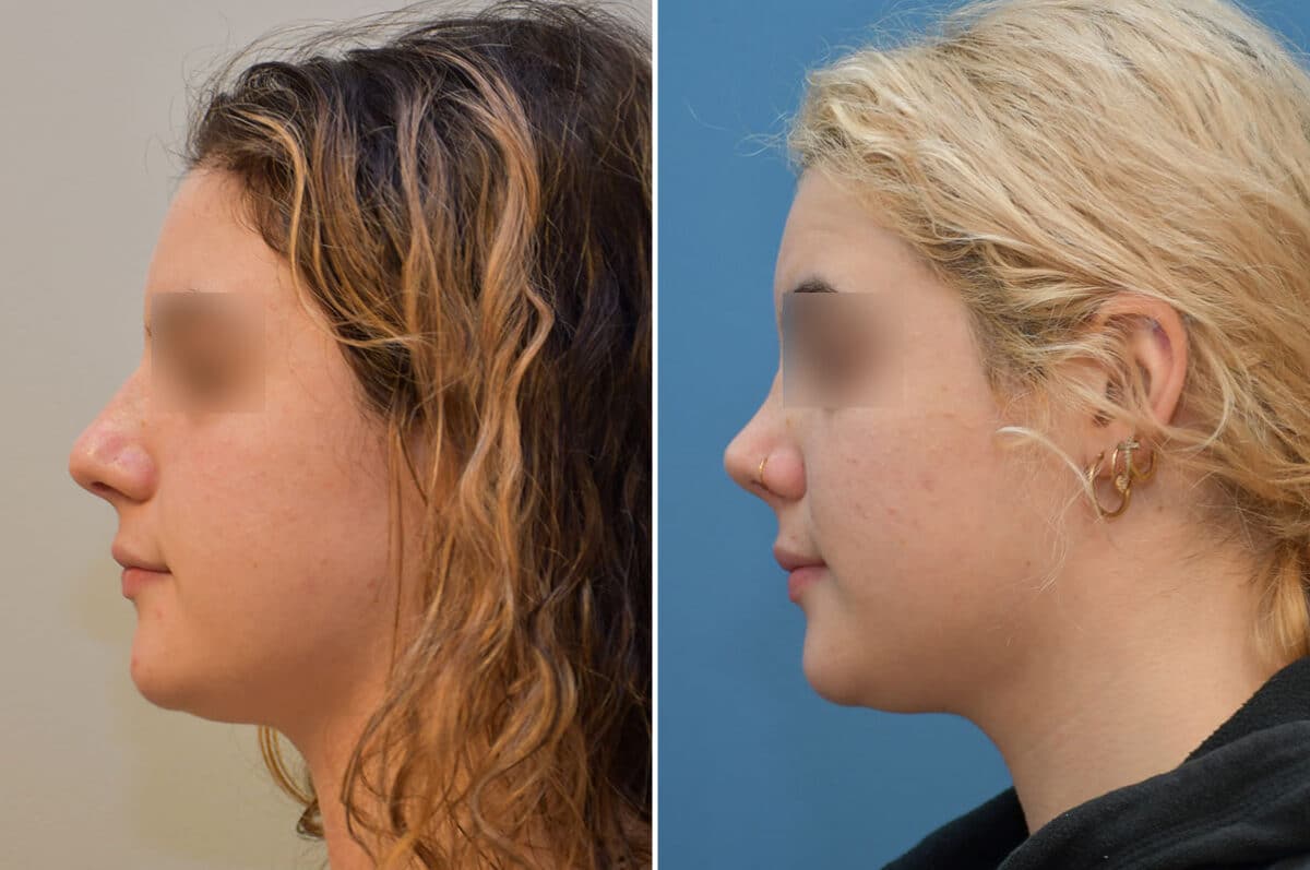 Patient 5808, Rhinoplasty Before and After Photos Rhinoplasty Before and After Photos in Philadelphia, PA, Patient 5808