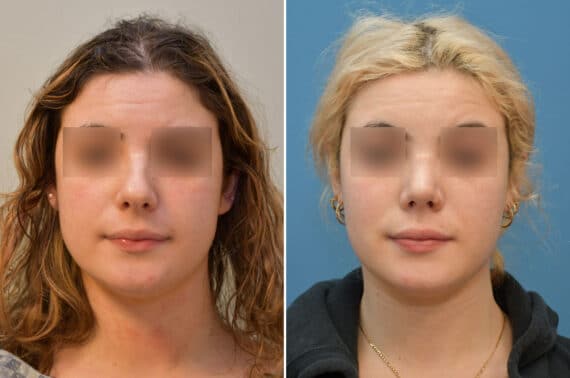 Rhinoplasty Before and After Photos in Philadelphia, PA, Patient 5808