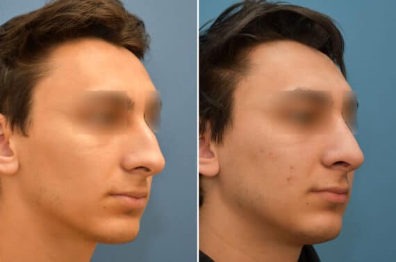 Rhinoplasty Before and After Photos in Philadelphia, PA, Patient 5824