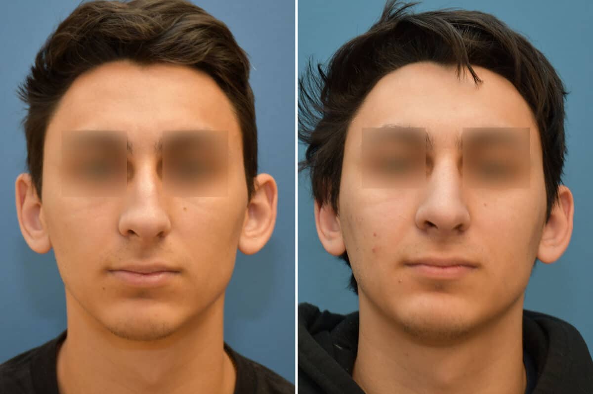 Patient 5824, Rhinoplasty Before and After Photos Rhinoplasty Before and After Photos in Philadelphia, PA, Patient 5824