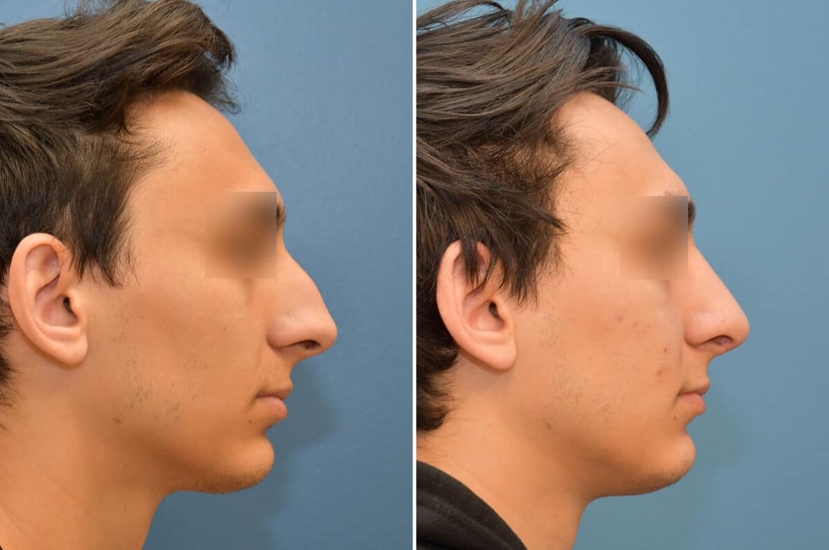 Patient 5824, Rhinoplasty Before and After Photos Rhinoplasty Before and After Photos in Philadelphia, PA, Patient 5824