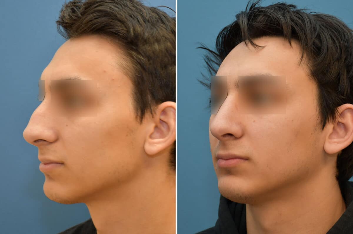 Patient 5824, Rhinoplasty Before and After Photos Rhinoplasty Before and After Photos in Philadelphia, PA, Patient 5824