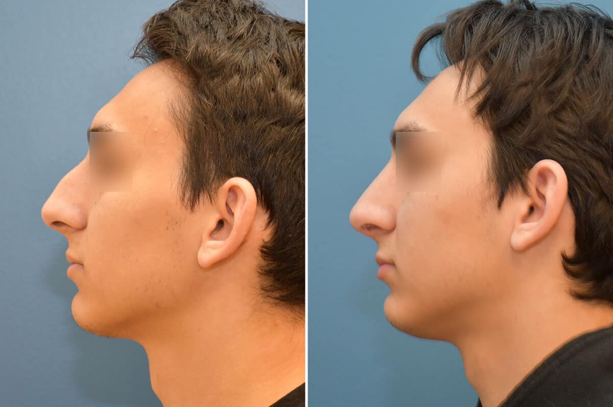 Patient 5824, Rhinoplasty Before and After Photos Rhinoplasty Before and After Photos in Philadelphia, PA, Patient 5824