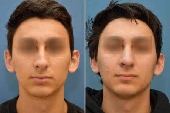 Rhinoplasty Before and After Photos in Philadelphia, PA, Patient 5824