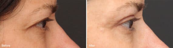 Upper Eyelid Surgery Before and After Photos in Philadelphia, PA, Patient 1031